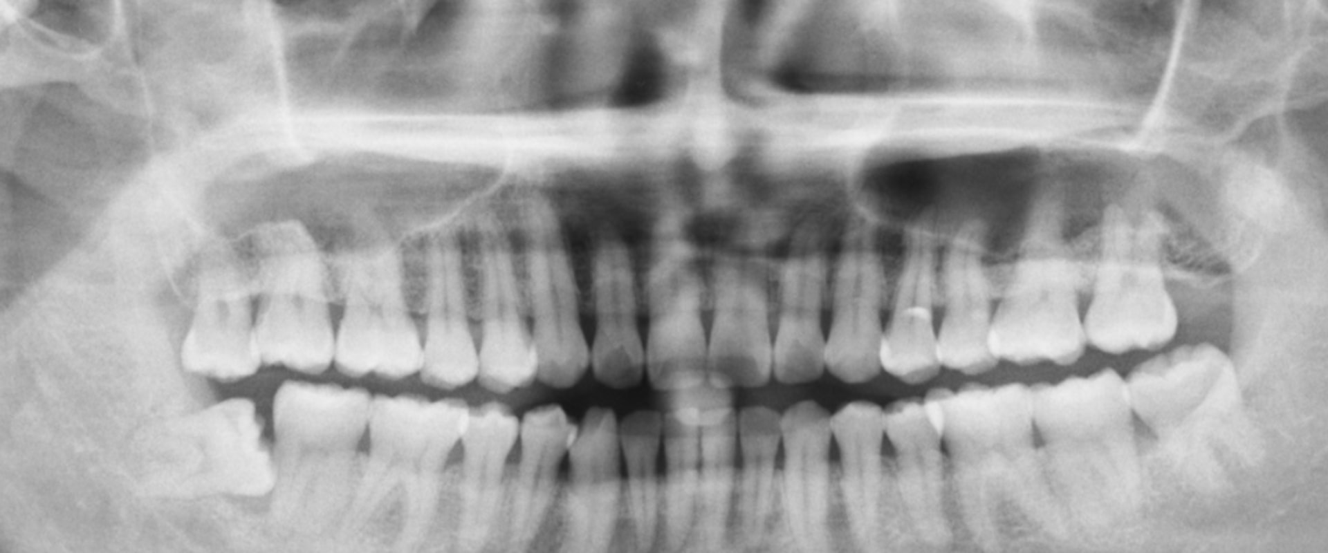 What does a full mouth xray show?