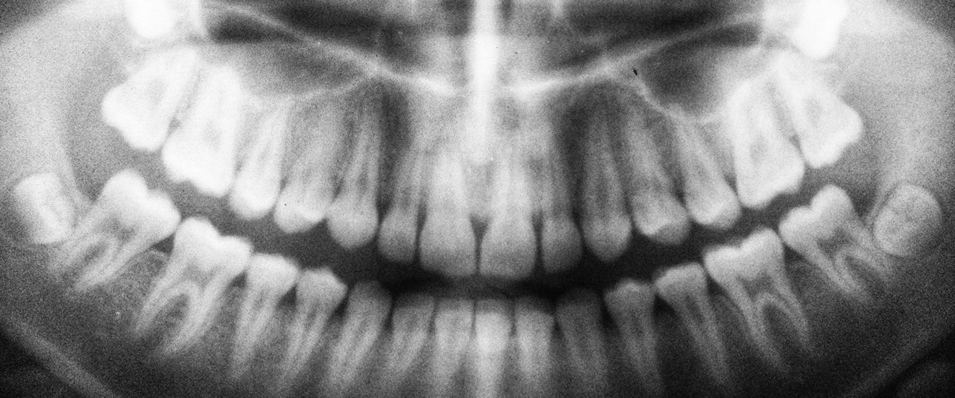 Are dental xrays bad for you?