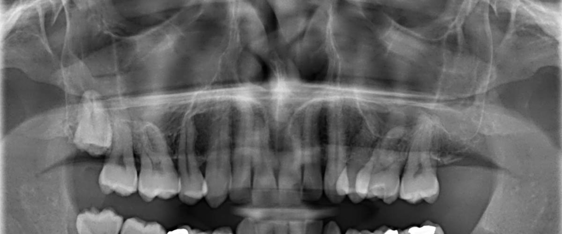 Can dental x rays show oral cancer?