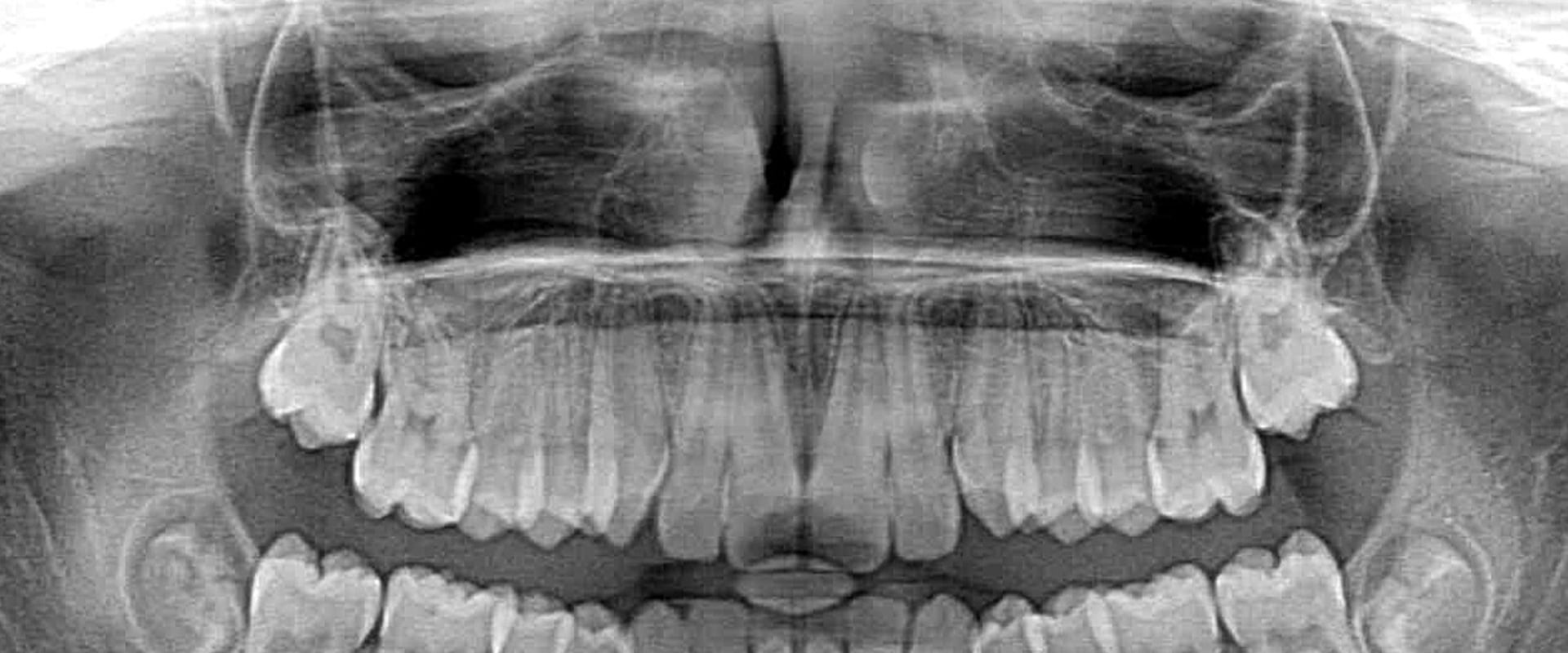 Are dental x rays needed every 6 months?