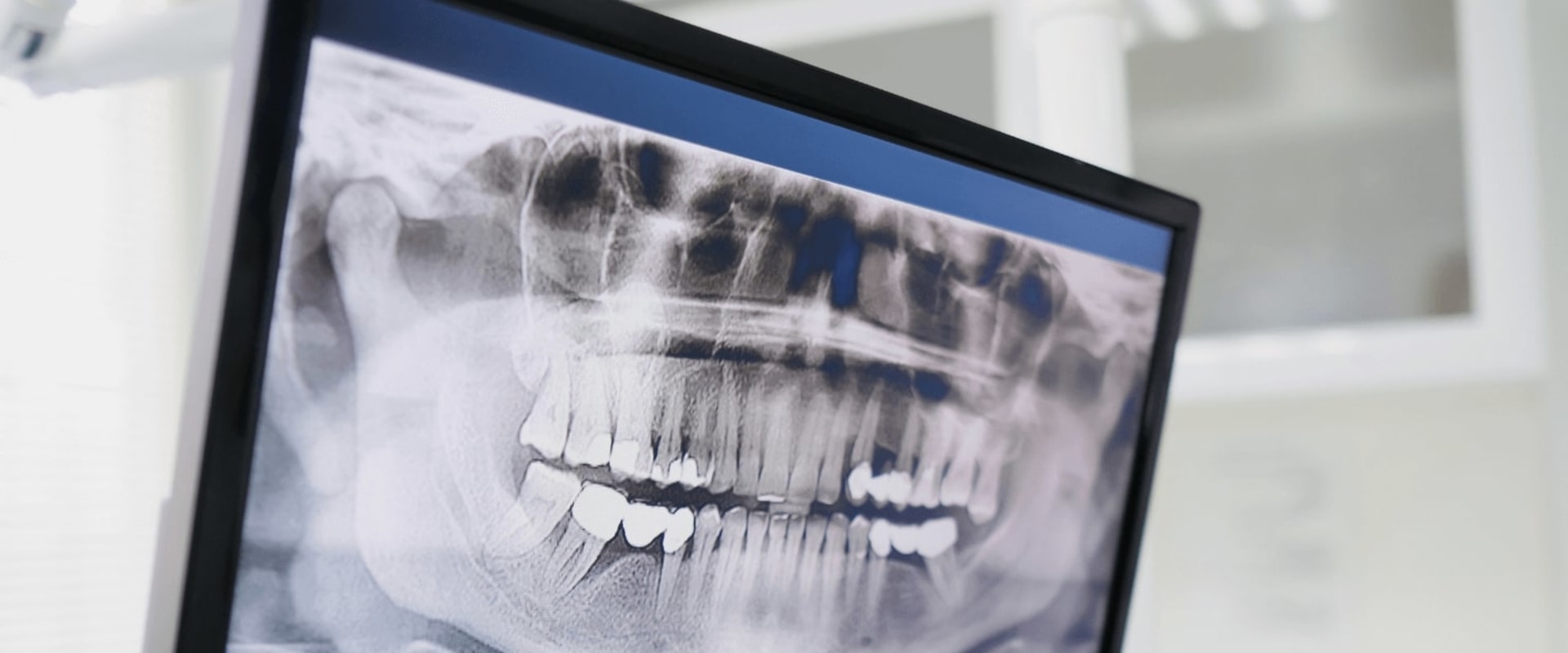 Which dental x ray gives the least amount of radiation?