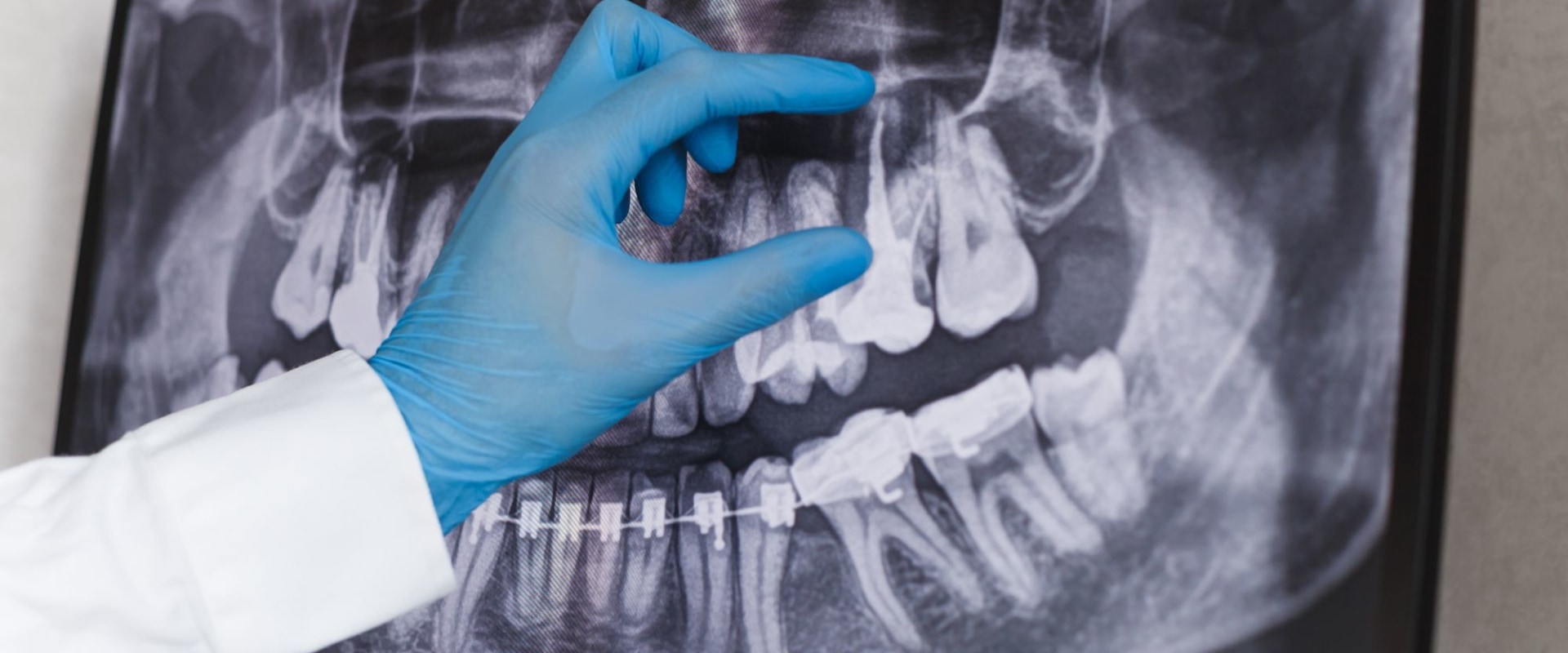 Why Dental XRays Are Essential Before Getting Dentures In Woden