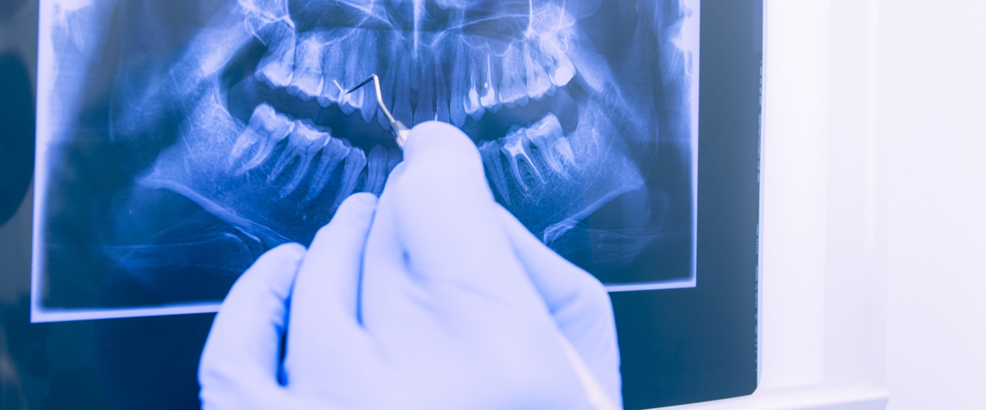 Do dental xrays have a lot of radiation?