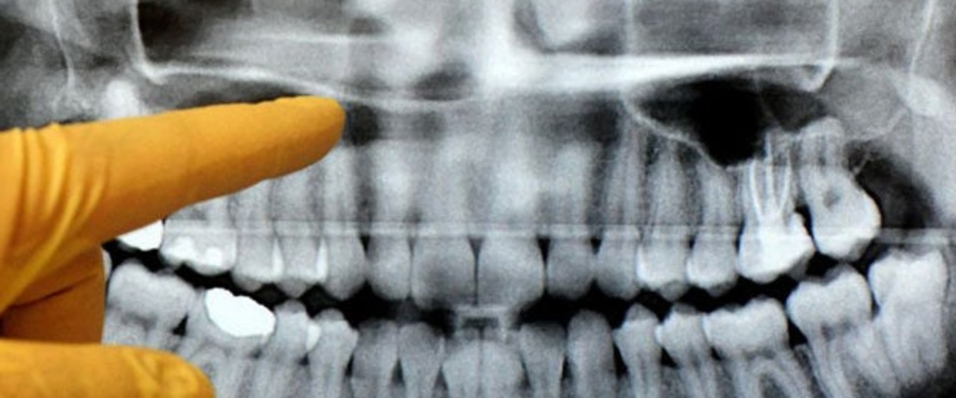 Can a dental panoramic x ray show cancer?