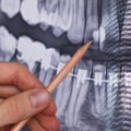What can dental x-rays detect?