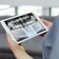 Your Veneers Start With Precision: Why Dental X-Rays Matter In Honolulu