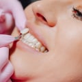 Unlocking Your Dream Smile: How Dental X-Rays Pave The Way For Veneers In Cedar Park, Texas