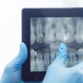 Understanding The Role Of Dental X-rays In Evaluating Dental Implant Candidates In Austin