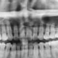 What does a full mouth x-ray show?