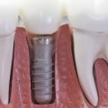 The Journey Of Dental Implants And The Crucial Role Of Dental X-Rays In Schertz, TX