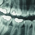 How often is safe for dental x-rays?