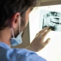 Why Are Dental X-Rays Required When Obtaining Dental Implants In Austin
