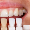 How Dental X-Rays Enhance The Placement Of Porcelain Veneers In Waco, TX
