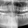 Are dental x rays dangerous?