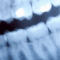 Who discovered dental x rays?