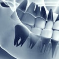 How do i know if i need dental x-rays?
