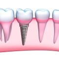 Achieve A Perfect Smile With Dental Implants: Unveiling The Journey Through Dental X-Rays In Austin, TX