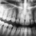 Are dental x-rays bad for you?