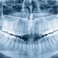 The Role of Dental X-Rays in Orthodontics in Seattle