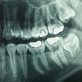 Should i worry about dental x-rays?