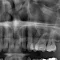 Can dental x rays show oral cancer?