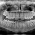 Are dental x rays needed every 6 months?