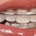 Why Dental X-rays Are Crucial For Proper Braces Placement In Georgetown And Austin