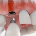 Which dental x ray gives the least amount of radiation?