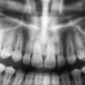 What Is The Importance Of Dental X-Rays In Dentistry In Austin, TX