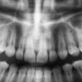 Dental X-Rays In San Antonio: Why They Are Essential For Good Oral Health