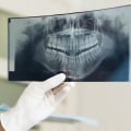 How To Determine If You Need A Dental X-ray Before Visiting A Dentist In New Jersey