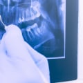 Why Dental X-Rays Are Essential Before Getting Dentures In Woden