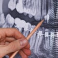 Do dental x-rays have a lot of radiation?