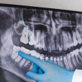 Understanding Dental X-Rays: A Guide From Your Borger Dentist