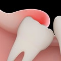 Can a dental panoramic x ray show cancer?