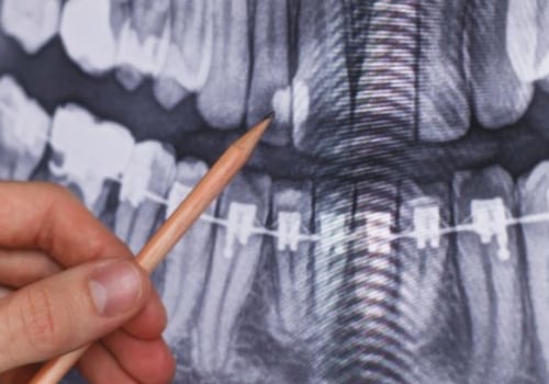 What can dental x-rays detect?