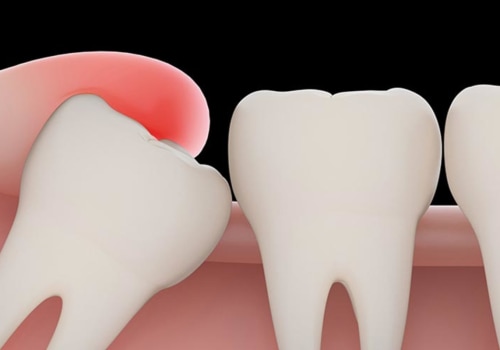 Why Do Emergency Tooth Extraction Procedures Need Dental X-Rays In London