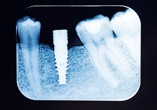How Dental X-Rays Influence Treatment Planning for Implants and Orthodontics