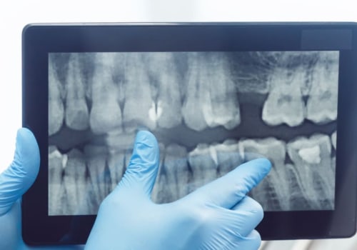 Understanding The Role Of Dental X-rays In Evaluating Dental Implant Candidates In Austin