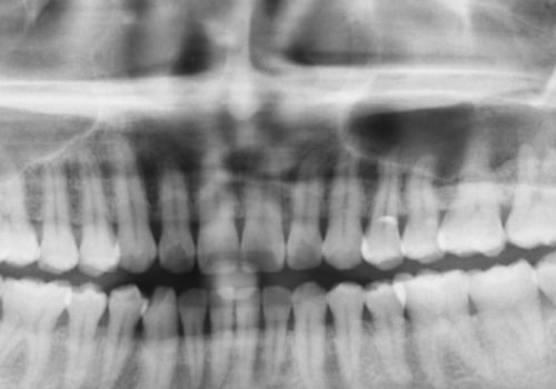 What does a full mouth x-ray show?