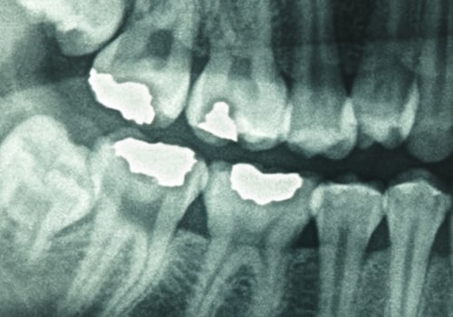 How do i ask for dental x-rays?
