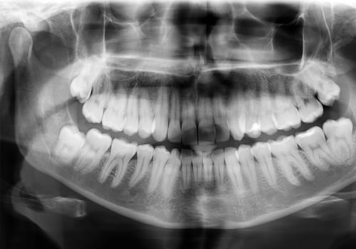 What is dental x ray?