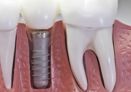 The Journey Of Dental Implants And The Crucial Role Of Dental X-Rays In Schertz, TX