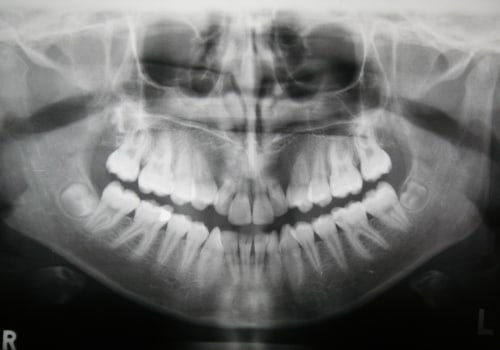 When are dental x rays necessary?