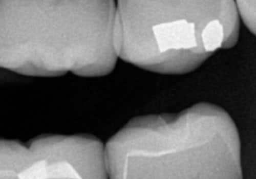 How often should dental x-rays be taken?