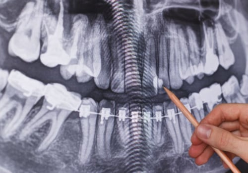 What are the different types of dental x-rays?