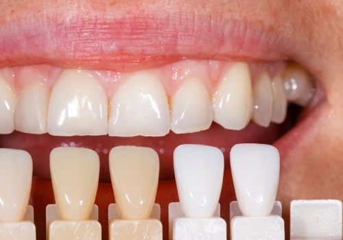 How Dental X-Rays Enhance The Placement Of Porcelain Veneers In Waco, TX