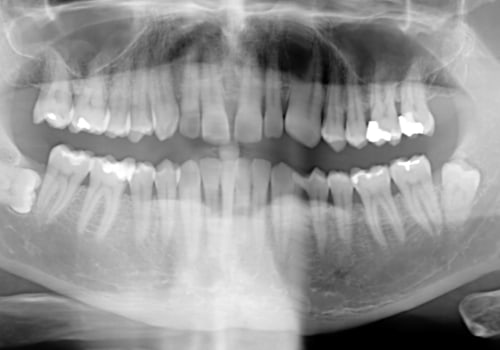 Are dental x rays dangerous?