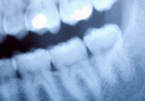 Who discovered dental x rays?