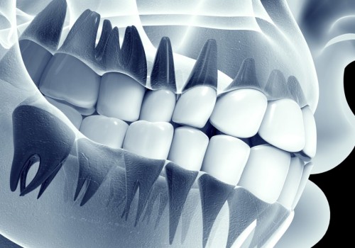 How do i know if i need dental x-rays?